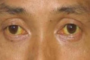 驳斥谣言中指变细是肝癌前期的体现医师这种塑料科普不看也罢