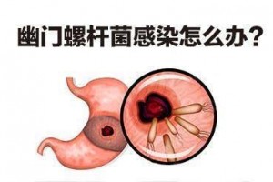 幽门螺杆菌有什么临床表现应该怎么治看完你就明白了