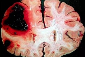身体出现10个异常十有八九是脑溢血及时检查别忽视 身体出现10个异常十有八九是脑溢血及时检查别忽视