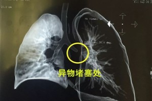 高度警惕儿童气管异物！