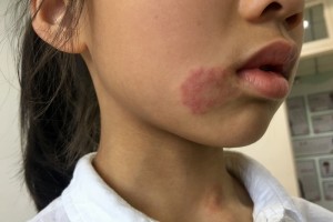 9岁女孩脸上身上出现多处红疹尤其是嘴角只因她每天亲小兔子 9岁女孩脸上身上出现多处红疹尤其是嘴角只因她每天亲小兔子
