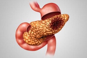 为什么胰腺癌被称为癌症之王医生说出了大实话看完就懂了 为什么胰腺癌被称为癌症之王医生说出了大实话看完就懂了