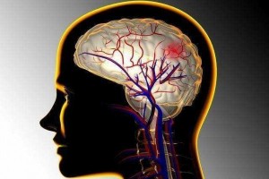 脑出血患者须严控血压 脑出血患者须严控血压