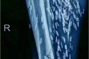 女子大腿小腿阴道里长满虫子满是由于吃了它很多人都爱吃 女子大腿小腿阴道里长满虫子满是由于吃了它很多人都爱吃