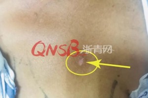 可怕60多岁大伯割草时一根钢针突然飞入胸腔直逼心脏…… 可怕60多岁大伯割草时一根钢针突然飞入胸腔直逼心脏……