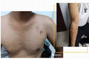 普定县人民医院顺利开展3例DSA引导下中心静脉造影并扩张术 普定县人民医院顺利开展3例DSA引导下中心静脉造影并扩张术