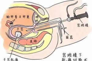 宫腔镜手术长什么样术后要注意什么 宫腔镜手术长什么样术后要注意什么
