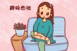 下肢静脉曲张竟然会与湿疹有关系 下肢静脉曲张竟然会与湿疹有关系