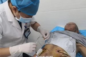 六旬大爷突发重症胰腺炎命悬一线经常饮食无规律所致 六旬大爷突发重症胰腺炎命悬一线经常饮食无规律所致
