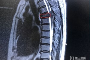 肿瘤一刀切≠痊愈2处转移如何带瘤生存 肿瘤一刀切≠痊愈2处转移如何带瘤生存