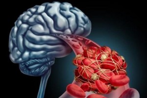 33岁男人深夜脑梗留下偏瘫一张嘴害了自己3类食物少吃点