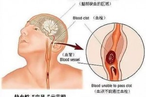 脑血栓后遗症又有哪些侯氏医馆提醒您要注意 脑血栓后遗症又有哪些侯氏医馆提醒您要注意