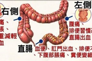 癌症已经有淋巴结搬运做手术还有含义吗是不是只能等死了 癌症已经有淋巴结搬运做手术还有含义吗是不是只能等死了