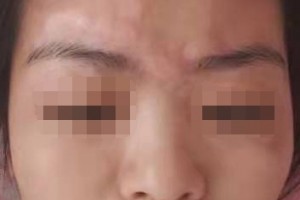 95后由于整容突发疾病后悔莫及 95后由于整容突发疾病后悔莫及