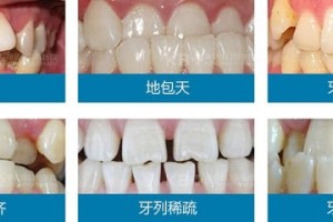 大连齿医师口腔科普三类人要做牙齿纠正牙齿纠正有6个过程 大连齿医师口腔科普三类人要做牙齿纠正牙齿纠正有6个过程
