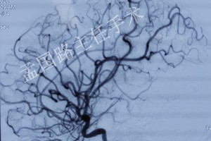 儿童丘脑底节区海绵状血管瘤手术——手术越是难做的部位越倾向于手术医治 儿童丘脑底节区海绵状血管瘤手术——手术越是难做的部位越倾向于手术医治