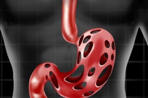 41岁男人查出胃癌医师2种菜要少吃胃易癌变 41岁男人查出胃癌医师2种菜要少吃胃易癌变