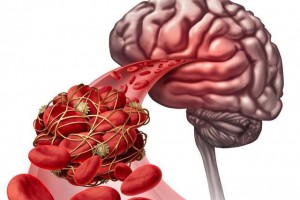 当心这10类人群易患脑中风 当心这10类人群易患脑中风