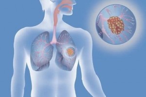 成功抗击肺癌2次医治后首要肿瘤从缩小到根本消失 成功抗击肺癌2次医治后首要肿瘤从缩小到根本消失