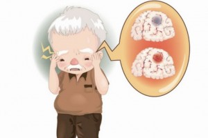继续头痛还不当回事大妈头痛2个月成果发现是肿瘤在捣乱 继续头痛还不当回事大妈头痛2个月成果发现是肿瘤在捣乱