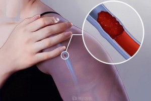 可怕静脉血栓构成和肿瘤常结伴而行居然与这3点原因有关早防备很重要 可怕静脉血栓构成和肿瘤常结伴而行居然与这3点原因有关早防备很重要
