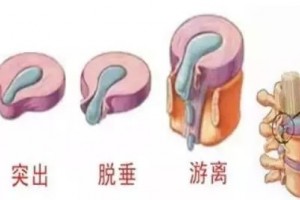 腰椎间盘突出的症状和缓解之道 腰椎间盘突出的症状和缓解之道