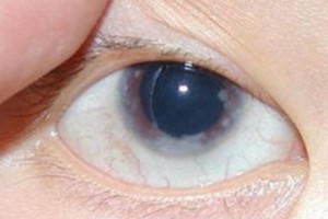 青光眼又称眼睛杀手防备青光眼的2个食疗小方了解下 青光眼又称眼睛杀手防备青光眼的2个食疗小方了解下