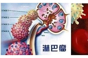 科学防备法远离淋巴瘤 科学防备法远离淋巴瘤