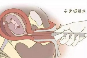 女人终身最多能接受几回人流 女人终身最多能接受几回人流
