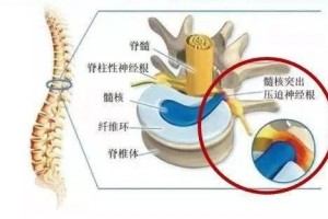 腰间盘突出终究是什么腰间盘突出压榨神经腿疼应该怎么做呢? 腰间盘突出终究是什么腰间盘突出压榨神经腿疼应该怎么做呢?