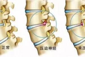 关于腰椎间盘突出症你不得不知道的几大误区 关于腰椎间盘突出症你不得不知道的几大误区